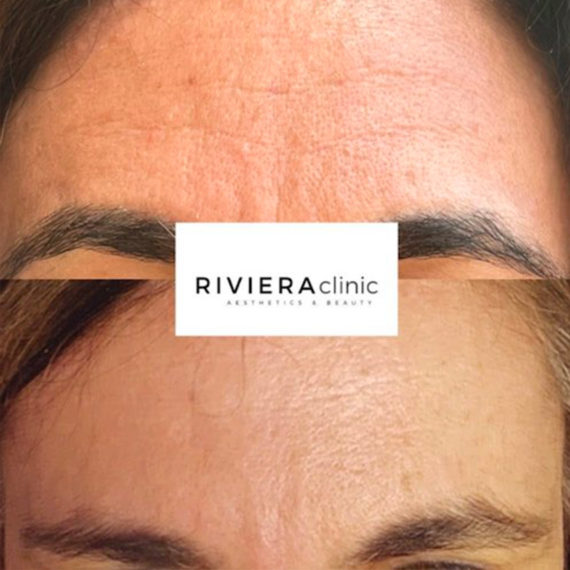 Résultat avant après toxine botulique -à la RIVIERAClinic
