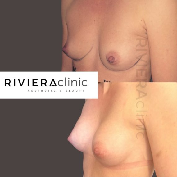 Résultat d'augmentation mammaire, chirurgie des seins. Réalisée par le Dr SMARRITO