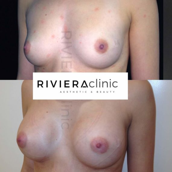 Résultat d'augmentation mammaire, chirurgie des seins. Réalisée par le Dr SMARRITO