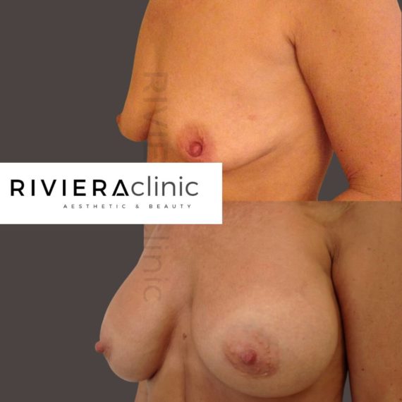 Résultat d'augmentation mammaire, chirurgie des seins. Réalisée par le Dr SMARRITO