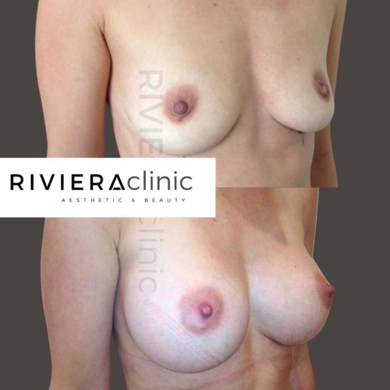 Résultat d'augmentation mammaire, chirurgie des seins. Réalisée par le Dr SMARRITO