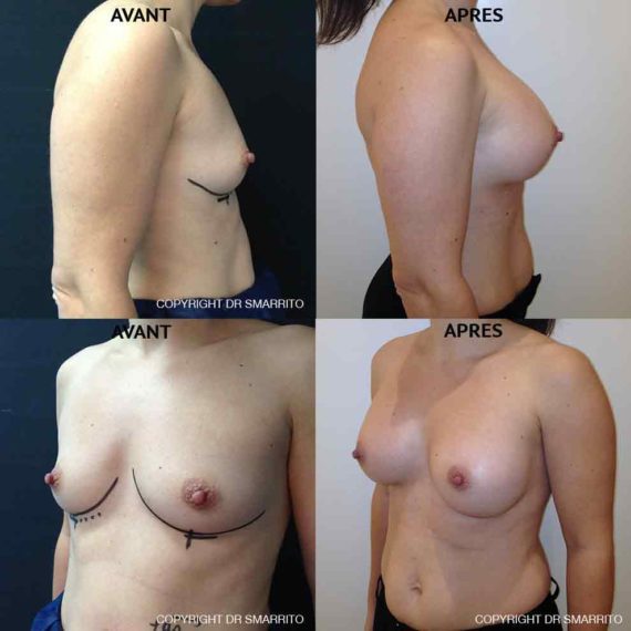 Résultat d'augmentation mammaire, chirurgie des seins. Réalisée par le Dr SMARRITO