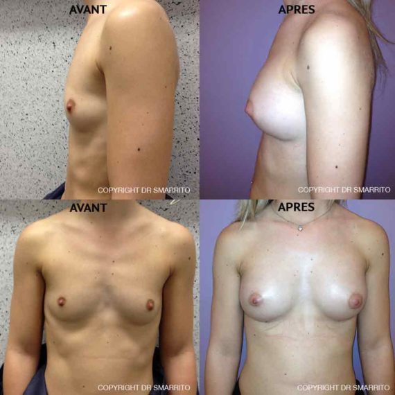 Résultat d'augmentation mammaire, chirurgie des seins. Réalisée par le Dr SMARRITO