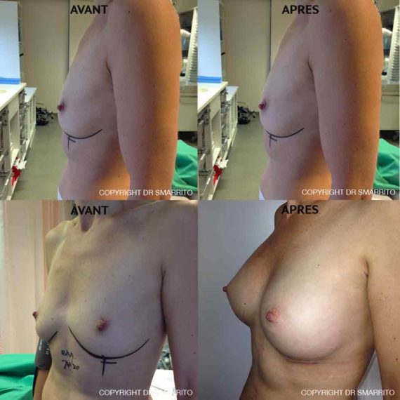 Résultat d'augmentation mammaire, chirurgie des seins. Réalisée par le Dr SMARRITO