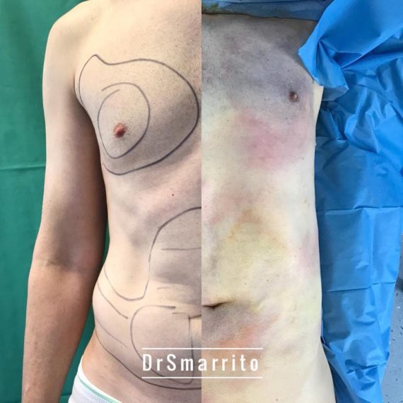 Résultat de liposuccion, chirurgie de la silhouette