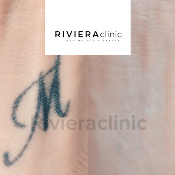 Résultat de détatouage laser de la rivieraclinic Lausanne