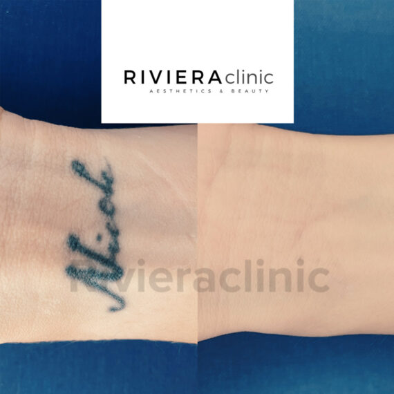 Résultat de détatouage laser de la rivieraclinic Lausanne