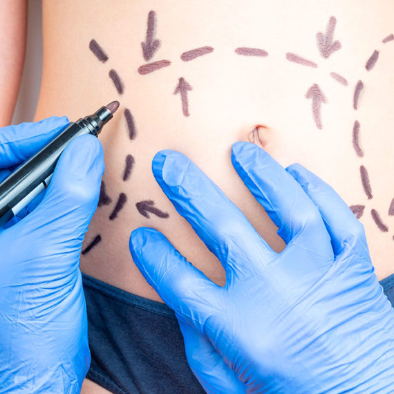 Les bonnes indications de cryolipolyse