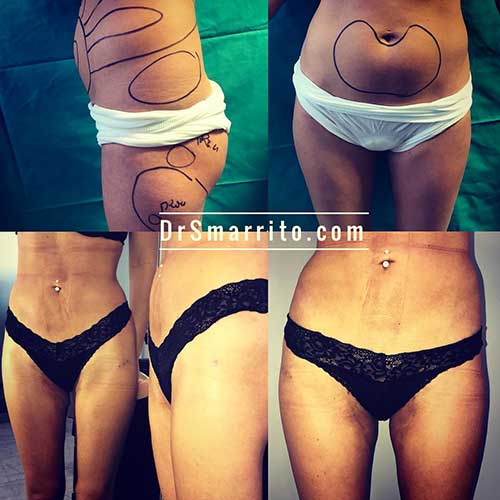 Résultat de liposuccion, chirurgie de la silhouette