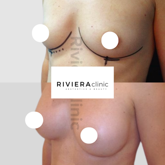 Résultat d'augmentation mammaire, chirurgie des seins. Réalisée par le Dr SMARRITO