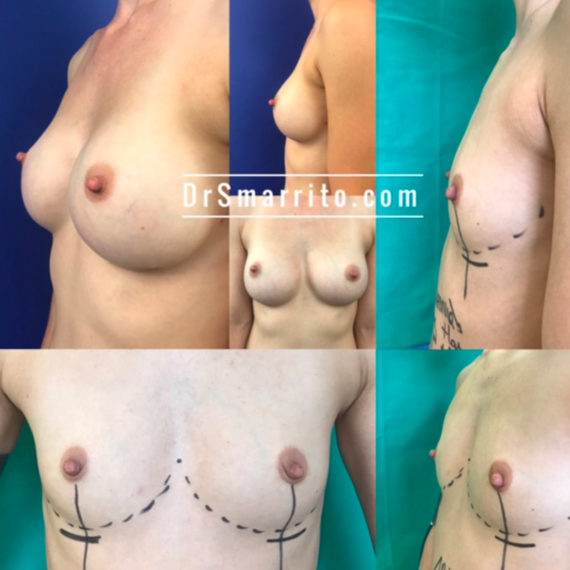 Résultat d'augmentation mammaire, chirurgie des seins. Réalisée par le Dr SMARRITO