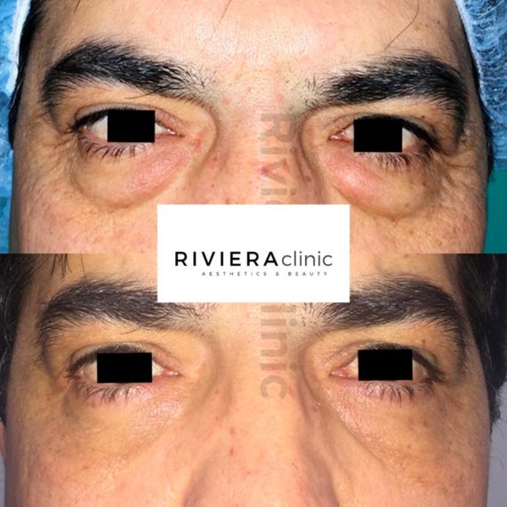 Résultat avant apres de chirurgie des paupieres du Dr SMARRITO