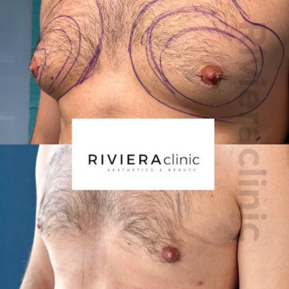 Résultat de gynécomastie, chirurgie des seins chez l'homme. Réalisée par le Dr SMARRITO