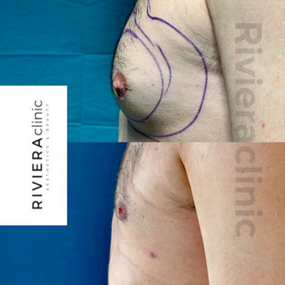 Résultat de gynécomastie, chirurgie des seins chez l'homme. Réalisée par le Dr SMARRITO