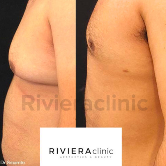 Résultat Avant après de gynécomastie, chirurgie des seins chez l'homme