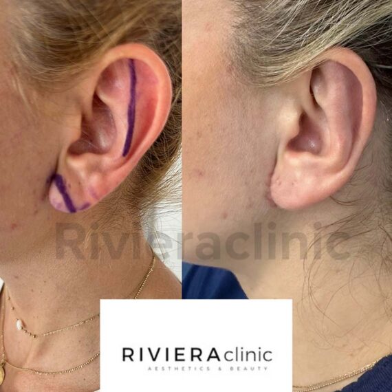 Résultat d'otoplastie, chirurgie des oreilles. Réalisée par le Dr SMARRITO
