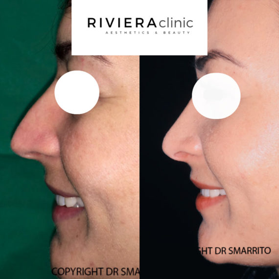 Résultat de rhinoplastie, chirurgie du nez, réalisée par le Dr SMARRITO