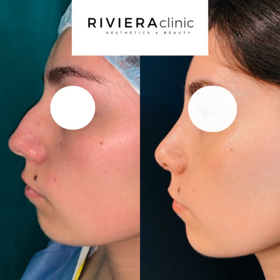 Résultat de rhinoplastie, chirurgie du nez. Réalisée par le Dr SMARRITO