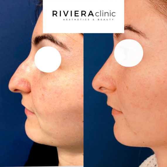 Résultat de rhinoplastie, chirurgie du nez. Réalisée par le Dr SMARRITO