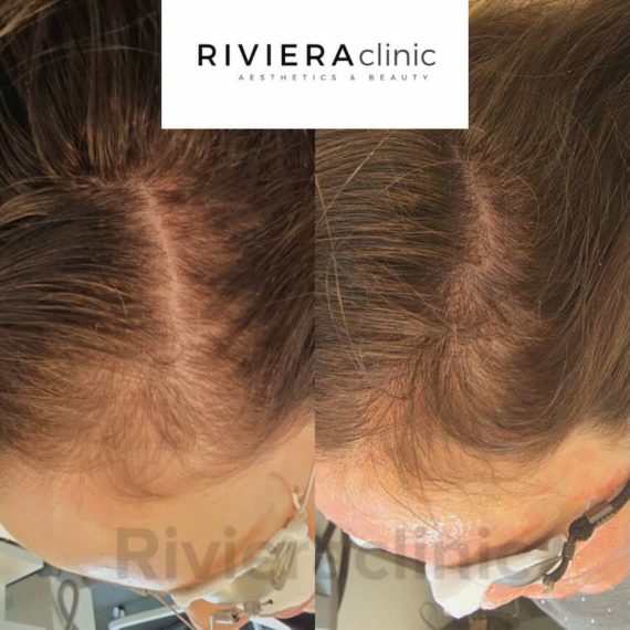 Exemple de résultat de 3 sessions de Hair vitality laser, traitement exclusif RIVIERAClinic