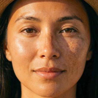 Mélasma et teint halé : Comment bronzer sans aggraver ses taches ?