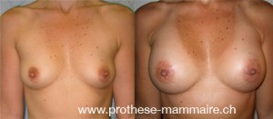 Augmentation mammaire 75C